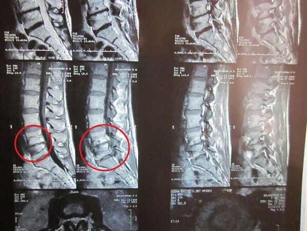 Διάγνωση της αυχενικής οστεοχονδρισμού