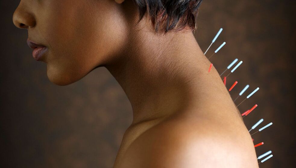 βελονισμός με αυχενική οστεοχονδρία