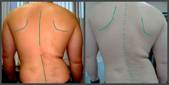 καμπυλότητα της σπονδυλικής στήλης με οστεοχονδρία