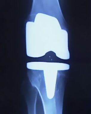 X -Ρύψτε την εικόνα του γόνατος με τεχνητή πρόθεση μετά την επιχείρηση για να αλλάξετε την άρθρωση