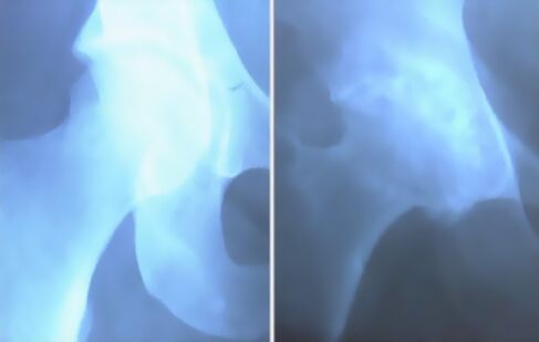 Αφθονία αρθρίσεως της άρθρωσης του γόνατος